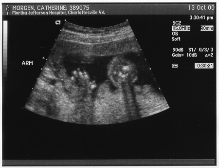 Another baby arm