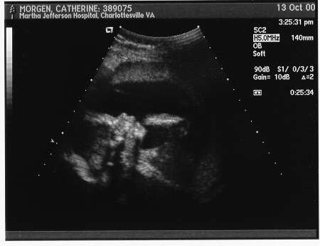 Baby's trying to suck her thumb