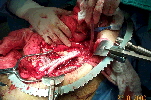Surgical picture with graft