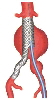 endovascular graft