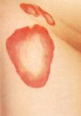 lyme disease rash