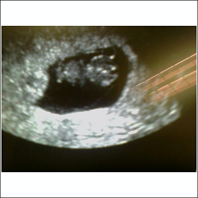 Baby Nicholas at 11 weeks