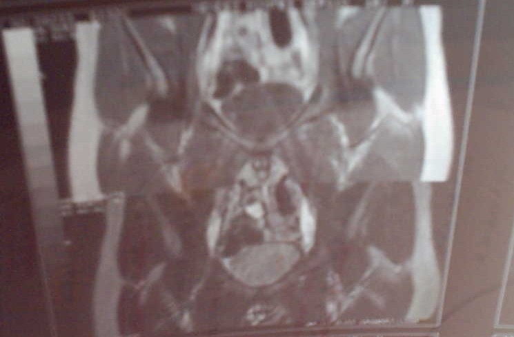 Resonancia Magn&eacute;tica