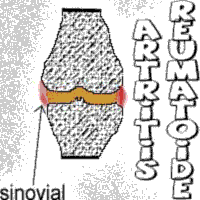 Artritis Reumatoide