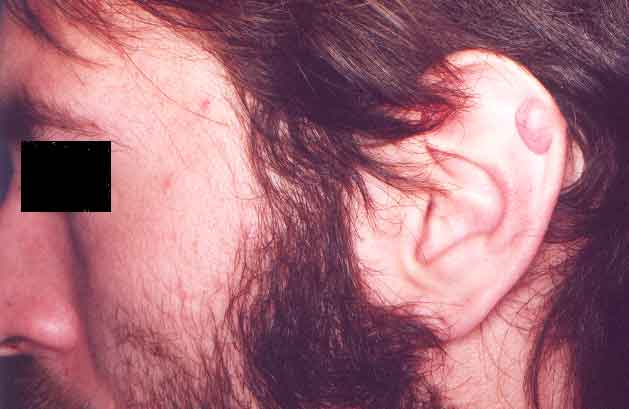 Cicatriz hipertr&oacute;fica tipo queloide posterior a la colocaci&oacute;n de un aro cuya herida se infect&oacute;.