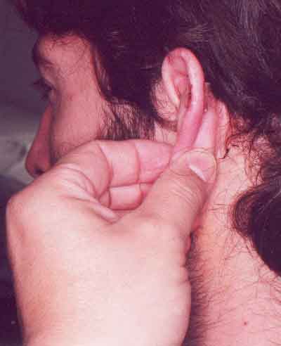 Paciente operado de su cicatriz tipo queloide, la misma que se extirp&oacute;  completamente, sin recidiva.