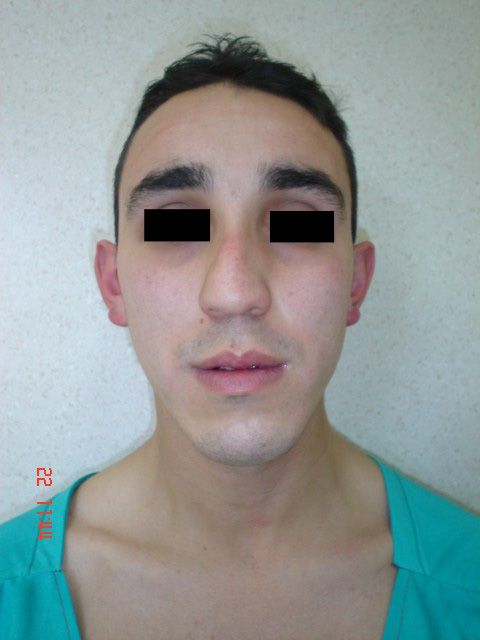 Paciente con rinodeformaci&oacute;n en su preoperatorio. Foto de frente.