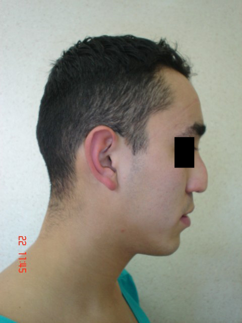 Paciente con rinodeformaci&oacute;n en su preoperatorio. Foto de perfil derecho