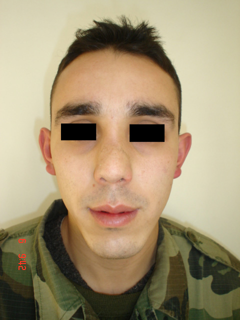 Paciente operado de rinopastia primaria, al mes de su postoperatorio