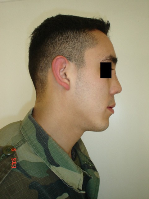 Fig. 4: Paciente masculino - Postoperatorio -Perfil derecho.