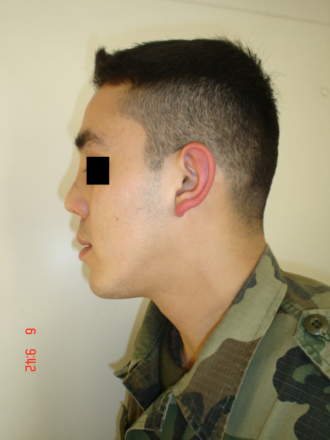 Fig. 5. Paciente masculino -  Postoperatorio - Vista de perfil izquierdo