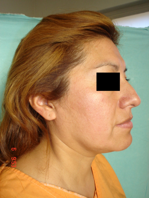 Fig. 7: Paciente Femenino -  Preoperatorio