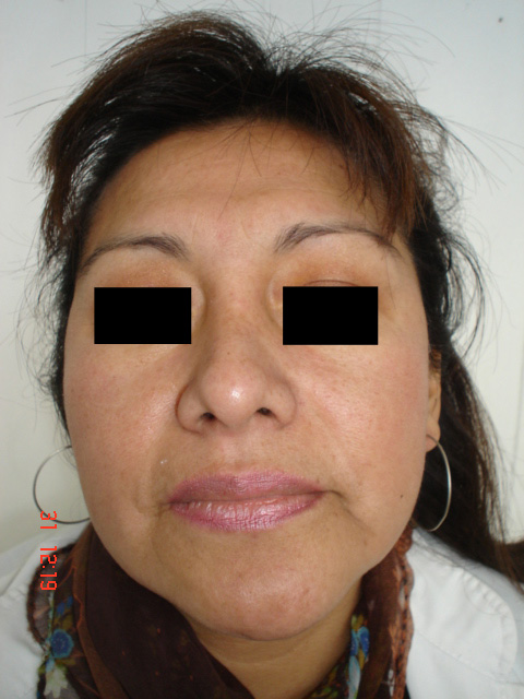 Fig. 8: Paciente femenino - Postoperatorio a 1 a&ntilde;o