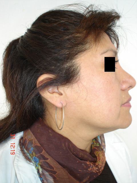 Fig. 9: Paciente femenino - Postoperaorio al a&ntilde;o