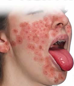 Pelagra