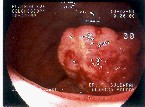 Imagen de un c�ncer de intestino grueso