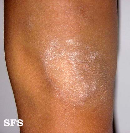 Stasis Dermatitis in Adults: Condition, Treatments, and ...