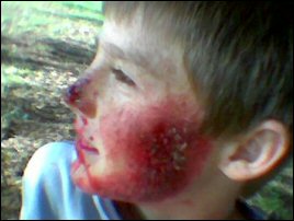Fake facial burns and damage