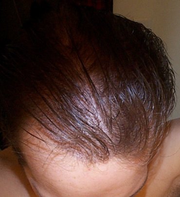 Scalp, scalp ... go away