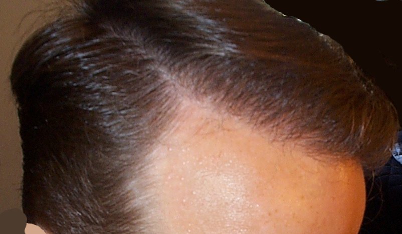 This is where most of the grafts were put in ...
