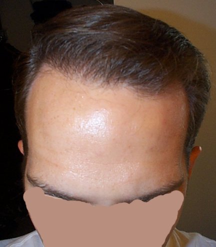 My, what a lovely forehead you have ...