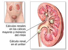 Ubicaci&oacute;n de los Calculos Renales