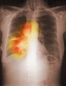 Enfermedad Cancer de pulmon