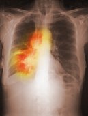 Enfermedad Cancer de pulmon