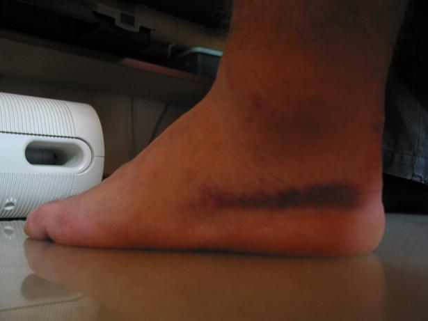 That is my foot as of August 17th.  Now it's worse.