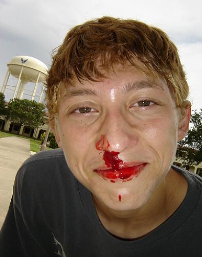 Logan's nose is pouring a stream of blood into his mouth.