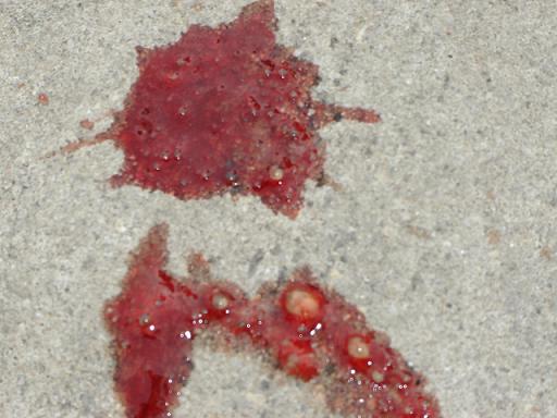 take a good look at the chunks in the blood