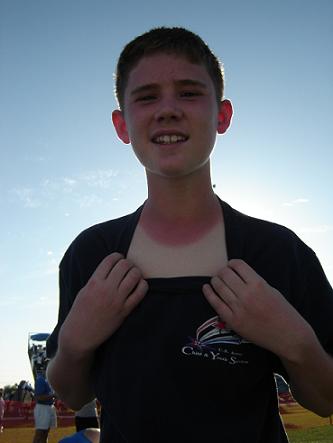Sun burn or just a red neck?