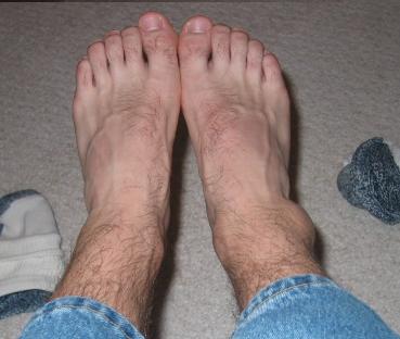 skateboard + ankle + gap66 = swollen