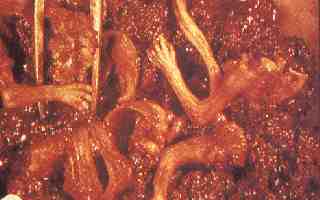 Aborto por succi�n