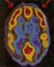 Imagen de tomograf�a computada del cerebro.