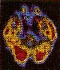 Imagen de tomograf�a computada del cerebro.