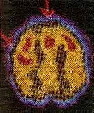 Imagen de tomograf�a computada del cerebro.