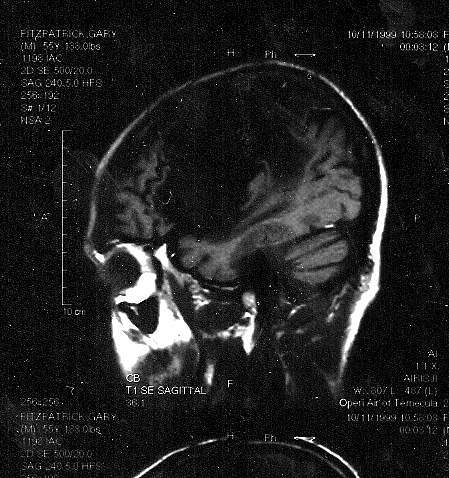 Gary brain image