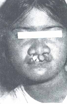 Cleft.jpg (28380 bytes)