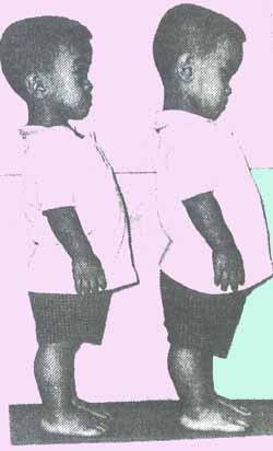 achondroplasia.jpg (17997 bytes)
