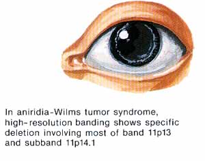aniridia.jpg (18220 bytes)