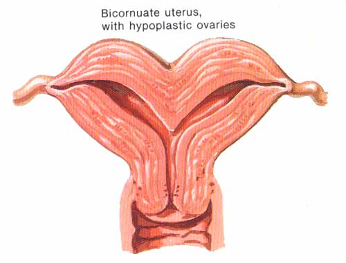 bicornuate.jpg (25097 bytes)