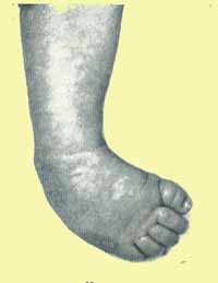 clubfoot.jpg (10405 bytes)
