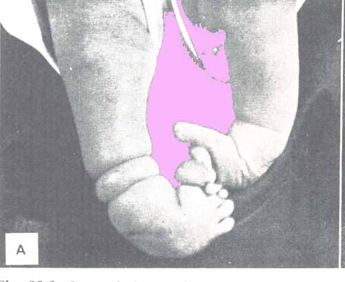 constricture_l.jpg (24621 bytes)