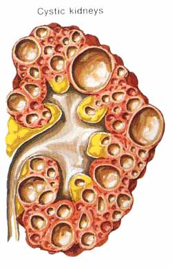 cystickidney.jpg (27153 bytes)