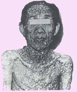 neurofibromatosis.jpg (23514 bytes)