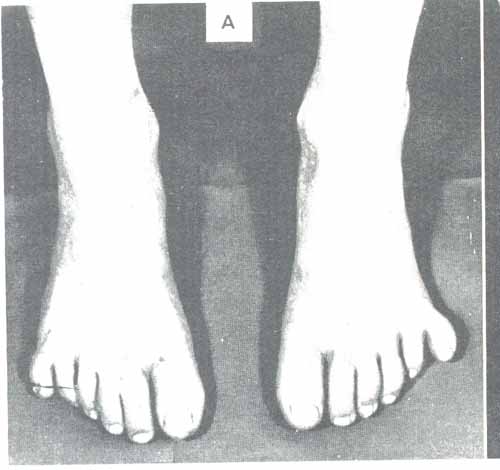 polydactyly_f.jpg (25732 bytes)