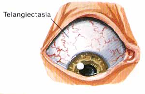 telangiectasia.jpg (15472 bytes)