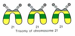 trisomy21b.jpg (13790 bytes)
