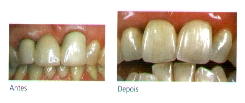 ips classic antes e depois
